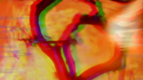 Solastalgia