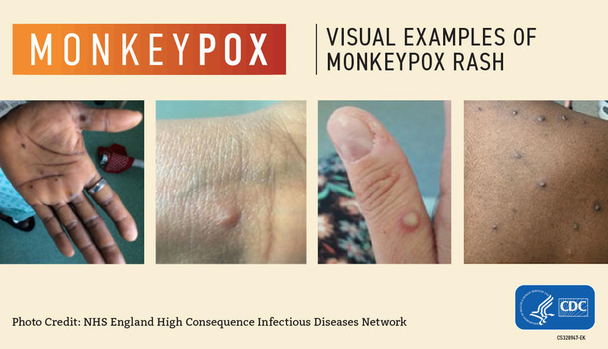 Monkeypox | The University of North Carolina at Pembroke