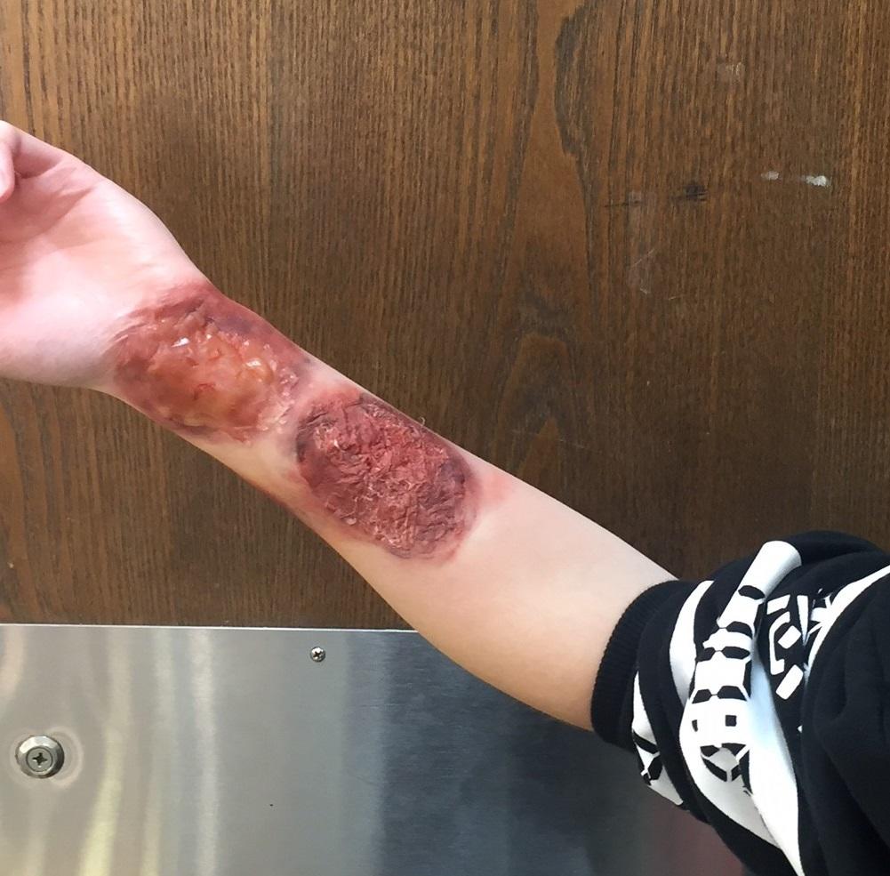 stage burns and bruises